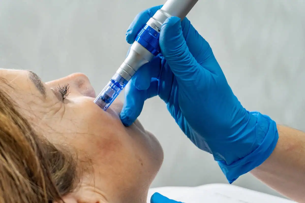 SkinPen Microneedling Treatment in Laguna Hills, CA at Bella Derm Aesthetics