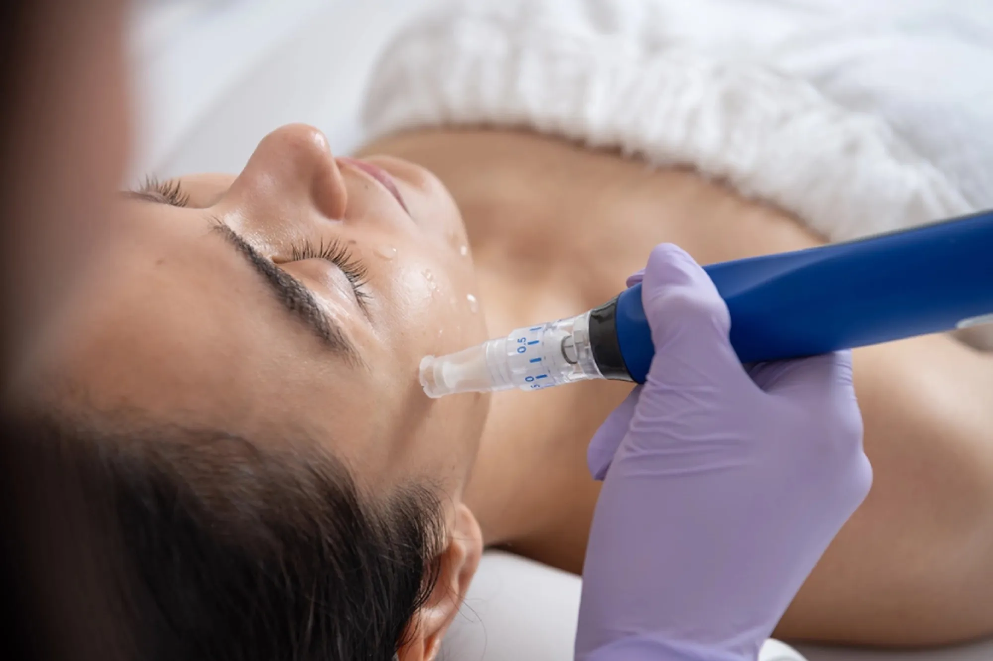 Microneedling Treatment in Laguna Hills, CA | Bella Derm Aesthetic